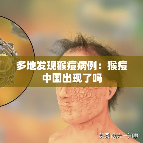 多地发现猴痘病例:猴痘中国出现了吗 多地发现猴痘病例:猴痘中国出现了吗